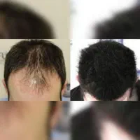 کاشت مو و ابرو تیم شیرازی در قزوین ، جشنواره اقساط|خدمات آرایشگری و زیبایی|قزوین, |دیوار
