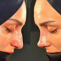 بلفاروپلاستی ،سانترال لب،لیفت ابرو،چربی صورت|خدمات آرایشگری و زیبایی|تهران, هروی|دیوار
