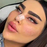 تزریق ژل.بوتاکس.انزیم.چال لپ‌.مزوپیرسینگ|خدمات آرایشگری و زیبایی|فردیس, فردیس|دیوار