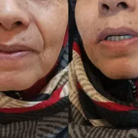 جشنواره زیبایی ژل بوتاکس هایفو جوانسازی پوست|خدمات آرایشگری و زیبایی|مشهد, گلبرگ شمالی|دیوار