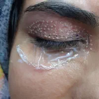 رفع افتادگی پلک و کوچک کردن بینی با پلاسما جت|خدمات آرایشگری و زیبایی|زنجان, |دیوار