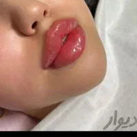 ژل فیلر بوتاکس مزو لیزر هایفو فیشیال خال مطب سلامت|خدمات آرایشگری و زیبایی|تبریز, |دیوار