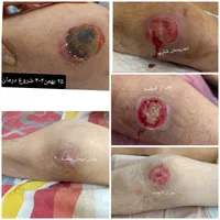 تزریقات درمنزل سرم کارشناس زخم.اصفهان و اطراف|خدمات آرایشگری و زیبایی|اصفهان, پارک مشتاق|دیوار
