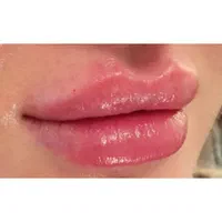 تخفیفات مدل ژل بوتاکس مزو،پاکسازی و جوانسازی صورت|خدمات آرایشگری و زیبایی|مشهد, طلاب|دیوار