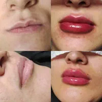 آموزش تخصصی ژل و بوتاکس پی ار پی نخ با مدرک|خدمات آموزشی|تهران, سعادت‌آباد|دیوار