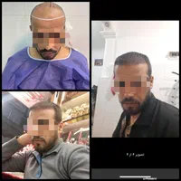 کاشت با ۶ تومان پیش پرداخت|خدمات آرایشگری و زیبایی|مشهد, ملک‌آباد|دیوار