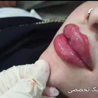 تزریق ژل و بوتاکس و کاشت نخ در کلینیک زیبایی|خدمات آرایشگری و زیبایی|خرم‌آباد, |دیوار