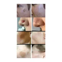 برداشتن انواع خال لک زیگیل تناسلی و...|خدمات آرایشگری و زیبایی|اصفهان, شهرک کوثر|دیوار