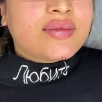 لیفت صورت با نخ. ژل.بوتاکس.مزوژل. درکلینیک