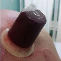 انجام و آموزش حجامت بانوان و آقایان