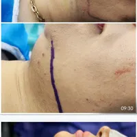 جشنواره ساکشن غبغب با تخفیف استثنایی|خدمات آرایشگری و زیبایی|اصفهان, مسجد مصلی|دیوار