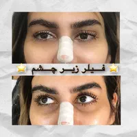 تزریق ژل بوتاکس فیلر تخفیف ویژه|خدمات آرایشگری و زیبایی|تهران, سبلان (لشگر)|دیوار