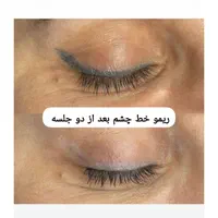 کیوسوئیچ، لیزر موهای زائد، هایفو، جوانسازی|خدمات آرایشگری و زیبایی|آبادان, |دیوار