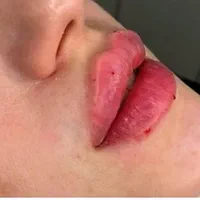 تزریق ژل و بوتاکس در تمام ایام حتی روزهای تعطیل