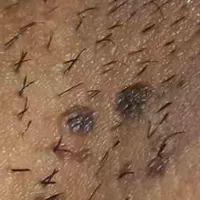 درمان زگیل،تبخال تناسلی خانمهاو آقایان،درمطب متخصص|خدمات آرایشگری و زیبایی|تبریز, |دیوار