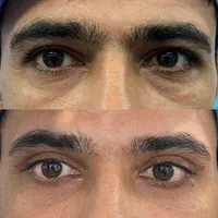 جراحی بینی ابدومینوپلاستی ساکشن پروتز بلفارو|خدمات آرایشگری و زیبایی|مشهد, احمدآباد|دیوار