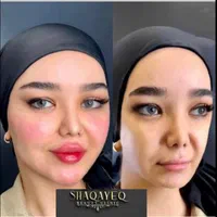 تزریق تخصصی ژل ومادلینگ وبوتاکس وهایفو|خدمات آرایشگری و زیبایی|کرمانشاه, |دیوار