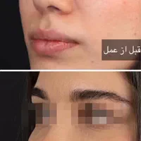 جراحی زیبایی بینی فقط با 22 میلیون|خدمات آرایشگری و زیبایی|قائم‌شهر, |دیوار