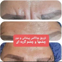 تزریق چربی صورت،ژل،بوتاکس،لیزر،لاغری|خدمات آرایشگری و زیبایی|رشت, گلسار|دیوار