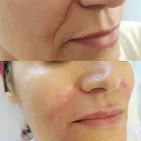 آموزش هیالورون پن کاشتمو آموزشگاه ژل بوتاکس|خدمات آموزشی|تهران, ستارخان|دیوار