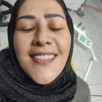 دست دندان مصنوعی طرح لمینت زیبایی تا ۶ ماه اقساط|خدمات آرایشگری و زیبایی|تبریز, |دیوار