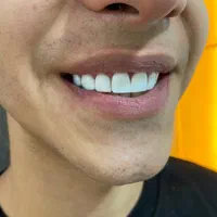 کامپوزیت دندان|خدمات آرایشگری و زیبایی|اسلام‌شهر, شهرک مهدیه|دیوار