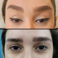 لیفت صورت وشقیقه،رفع غبغب