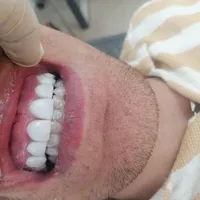 کامپوزیت هر فک فقط 4میلیون|خدمات آرایشگری و زیبایی|کرج, شهرک بنفشه|دیوار