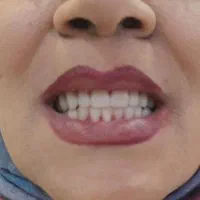 دندان مصنوعی دندانسازی اطمینان(فقط 6 میلیون تومان)|خدمات آرایشگری و زیبایی|اصفهان, کشاورزی|دیوار