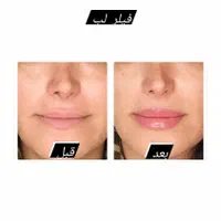 ژل بوتاکس مزوتراپی مزوژل سابسیژن/آموزش/در منزل|خدمات آرایشگری و زیبایی|تهران, تهرانپارس غربی|دیوار