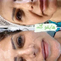 لیپوساکشن شکم و پهلو، ترنسفر به باسن،هایفودابلو|خدمات آرایشگری و زیبایی|اصفهان, دشتستان|دیوار