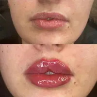 ژل و بوتاکس فیلر بینی نخ لیفت|خدمات آرایشگری و زیبایی|قم, صفائیه|دیوار