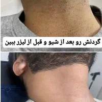 لیزر موهای زائد لیزر آقایان لیزر بانوان لیزر خانم|خدمات آرایشگری و زیبایی|اصفهان, سعادت‌آباد|دیوار