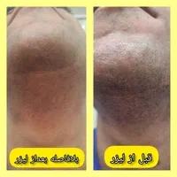 کلینیک تخصصی لیزر موهای زائد(الکساندرایت آمریکای)|خدمات آرایشگری و زیبایی|خرمشهر, |دیوار