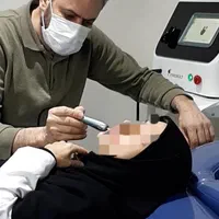 رفع افتادگی پلک و کوچک کردن بینی با پلاسما جت|خدمات آرایشگری و زیبایی|زنجان, |دیوار
