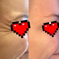 جشنواره تزریق ژل بوتاکس و جوانسازی