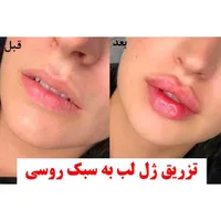 مدل تزریق زیبایی