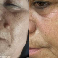 بوتاکس فیلر پی آر پی مزوتراپی زگیل تناسلی|خدمات آرایشگری و زیبایی|تبریز, |دیوار