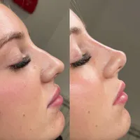 آنزیم ترکیبی بینی گوشتی،لیفت بینی،ژل لب،مزوتراپی|خدمات آرایشگری و زیبایی|تهران, سعادت‌آباد|دیوار