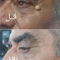 فصد پیشانی ،خالبرداری حجامت ، زالو و بادکش|خدمات آرایشگری و زیبایی|اهواز, کوی مهدیس|دیوار