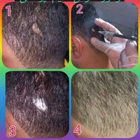 فریز زگیل میخچه/پزشک/بهارستان/خالبرداری|خدمات آرایشگری و زیبایی|اصفهان, بهارستان|دیوار