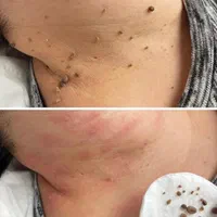 خال برداری و رفع انواع خال و خالبرداری|خدمات آرایشگری و زیبایی|اهواز, کیانپارس |دیوار