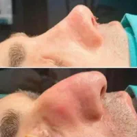 بلفاروپلاستی ،سانترال لب،لیفت ابرو،چربی صورت|خدمات آرایشگری و زیبایی|تهران, هروی|دیوار