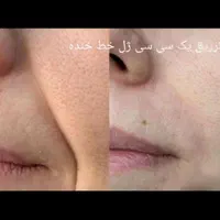 مطب ژل وبوتاکس لب لیفت با نخ رفع گودی چشم جدید|خدمات آرایشگری و زیبایی|گرگان, |دیوار