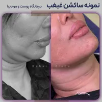 رفع و ساکشن غبغب 100% تضمین کتبی|خدمات آرایشگری و زیبایی|تهران, صادقیه|دیوار