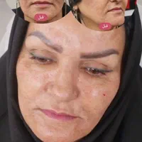 بوتاکس، ژل، چربی، لیزر، هایفوتراپی توسط پزشک|خدمات آرایشگری و زیبایی|یزد, |دیوار