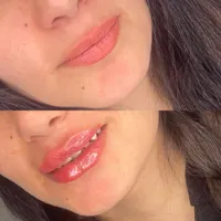 بوتاکس صورت ومعده ژل تزریق چربی عمل پلک ساکشن غبغب