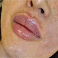 سابسیژن فیلر اندولیفت ژل بادی هایفو مزو بوتاکس|خدمات آرایشگری و زیبایی|کرج, مهرویلا جنوبی|دیوار