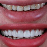 کامپوزیت دندان لمینت ایمپلنت دندانپزشکی عصبکشی|خدمات آرایشگری و زیبایی|شیراز, قصرالدشت|دیوار