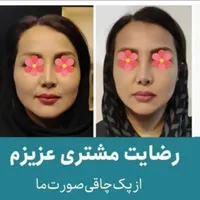 چاقی صورت بدون بازگشت با جوانه گندم